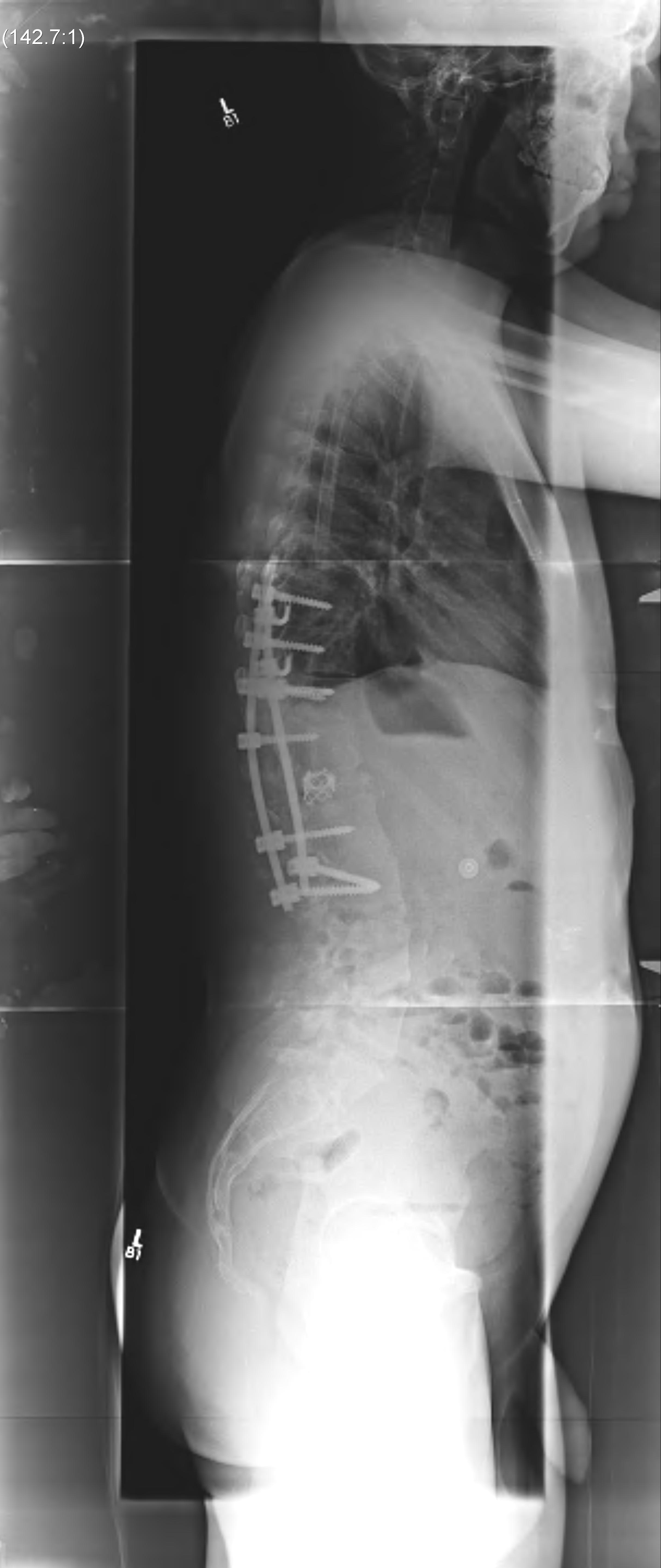 Congenital Kyphosis Correction Lateral